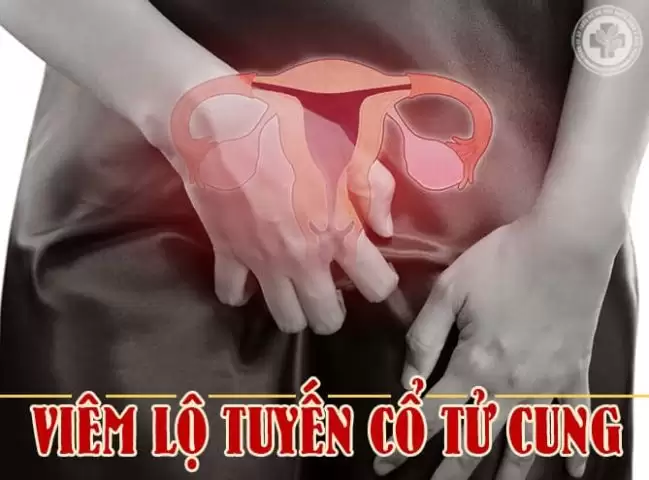Viêm lộ tuyến cổ tử cung Dấu hiệu, nguyên nhân và cách điều trị hiệu quả