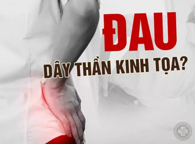 Đau dây thần kinh tọa: Nguyên nhân, triệu chứng và cách điều trị dứt điểm