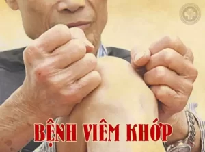 Bệnh viêm khớp: Triệu chứng điển hình và cách điều trị giúp người bệnh thoát khỏi đau nhức